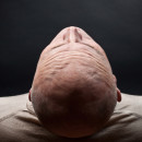 male pattern baldness