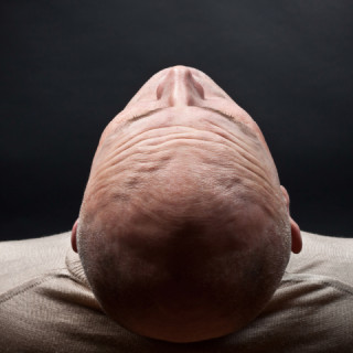 male pattern baldness